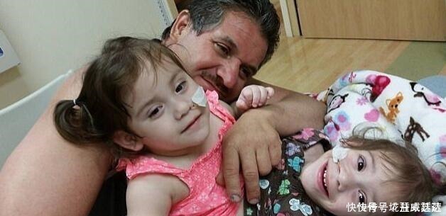 父母|连体双胞胎做分离手术成功,每人分得一条腿,父母喜极而泣!