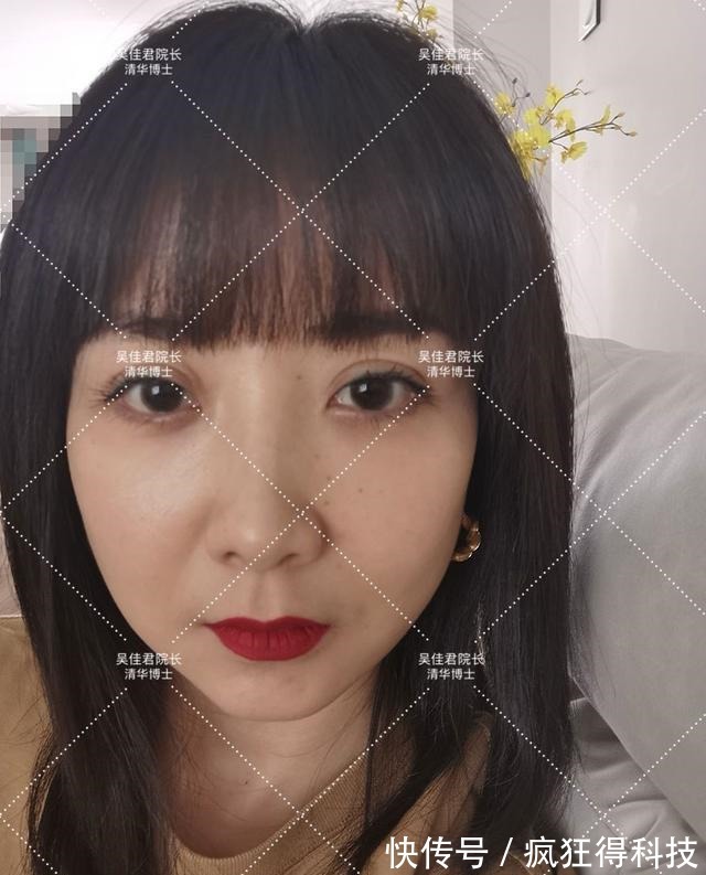 面部 小拉皮术后8个月,她从松垮阿姨脸秒变紧致少女脸!
