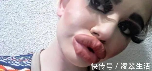 sofia 21次丰唇手术之后，这个妹子的嘴唇现在长这样…