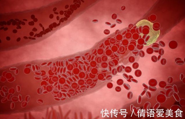 饱和脂肪酸|血脂高不高,看头就懂,若没有出现这3大症状,你就知足吧