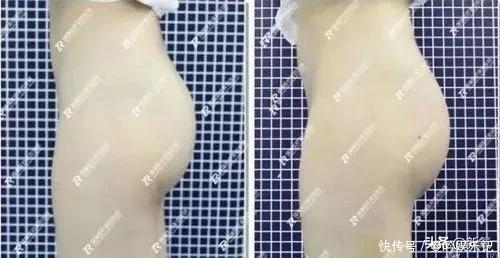 半个娱乐圈女明星脸上都有的这个坑，真的是线雕的锅吗？