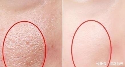 小疙瘩|抿紧下巴后突起的“白疙瘩”,千万要注意,这是螨虫的真身吗