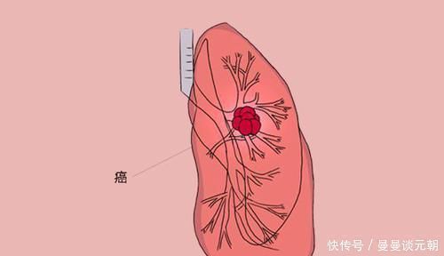 非小细胞癌|得了肺癌,究竟还能活多久熬过五年生存期,是不是就安全了
