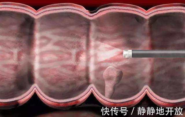 症状|三个症状不断出现,十有八九是大肠癌,最好去检查一下