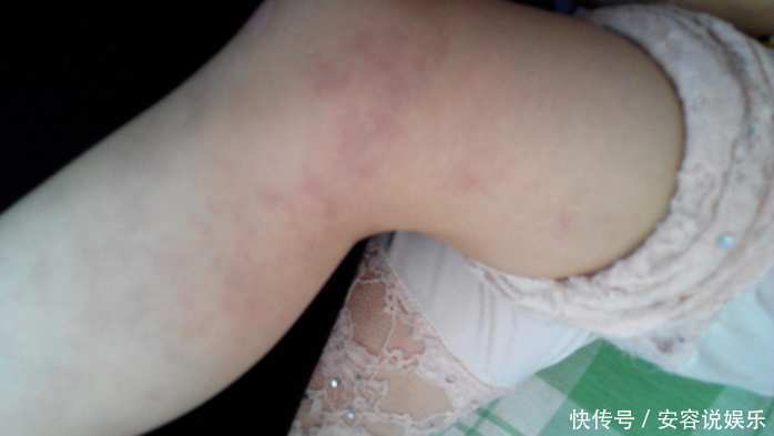 宝宝|1岁多的宝宝大腿一碰就哭,医生检查后从腿里取出了这个东西!