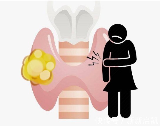 癌症|甲状腺结节“癌变”时，并不是悄无声息，有3个特征需提高警惕