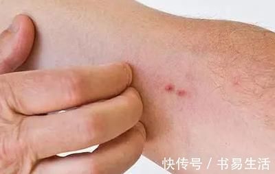 毒素|身上出现“二痒一痛”,要尽早重视,不要拖延,以免拖出肝病!