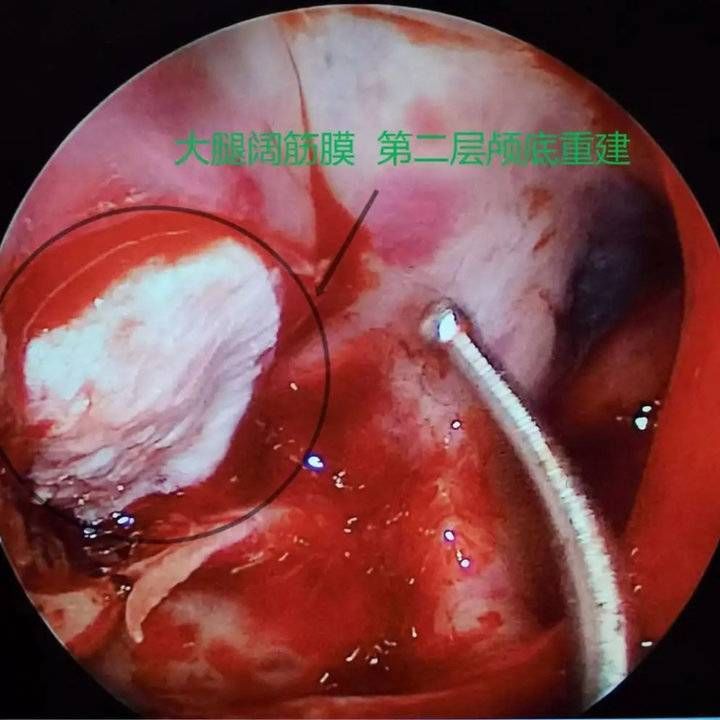 鼻内镜|流“鼻涕”一个多月,竟是脑脊液!鼻内镜下脑脊液修补术解难题