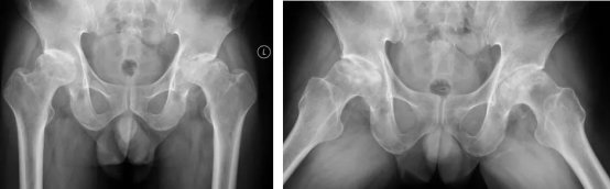 杭州|杭州65岁大伯股骨头坏死，只因他有这个习惯！这几类人是高发人群