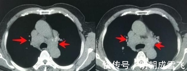 病人|癌症晚期病人差异这么大？有人可以5年以上，有人只有9天寿命？