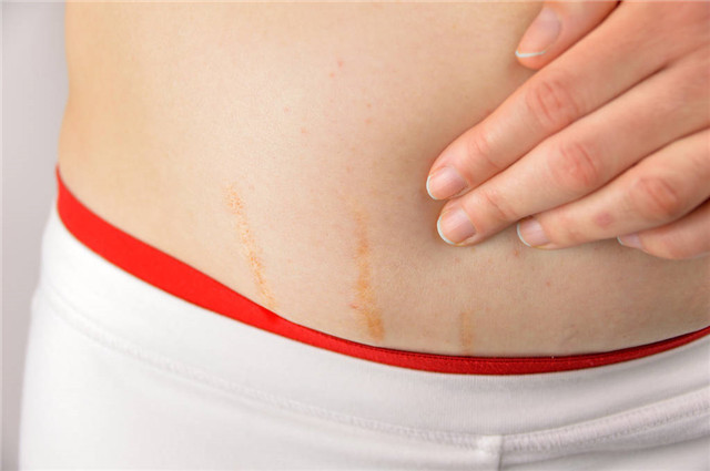 皮肤|准妈妈如何祛除妊娠纹?