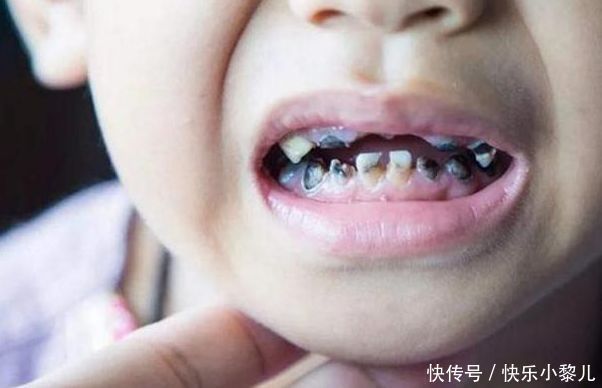 手指套|2岁孩子有了小黑牙,可能和糖果无关,跟爸妈的这些坏习惯有关