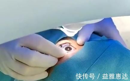 眼睛|做近视手术到一半，如果眼睛动了、眨了，会怎么样？