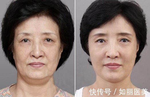 step 热玛吉价格一般是多少?千万别掉坑!