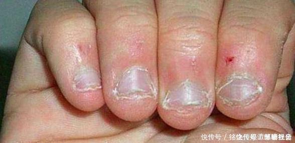 专家|从小“咬指甲”的孩子，长大后怎么样了专家逃不掉2种结局