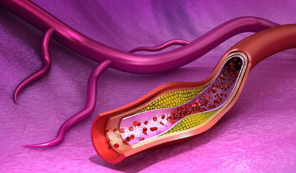 血管狭窄|血管一天比一天狭窄，三种食物最好多吃一点，能离血栓更远