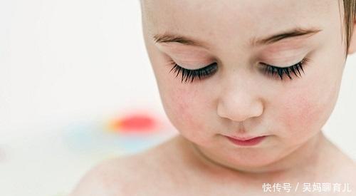 皮肤病|痒痒痒!湿疹这“妖孽”很磨人,反反复复怎么破?五招轻松护理