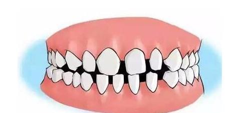 牙齿矫正|儿童做牙齿矫正三个最佳时间:家长要牢记,矫治越早干预效果越好