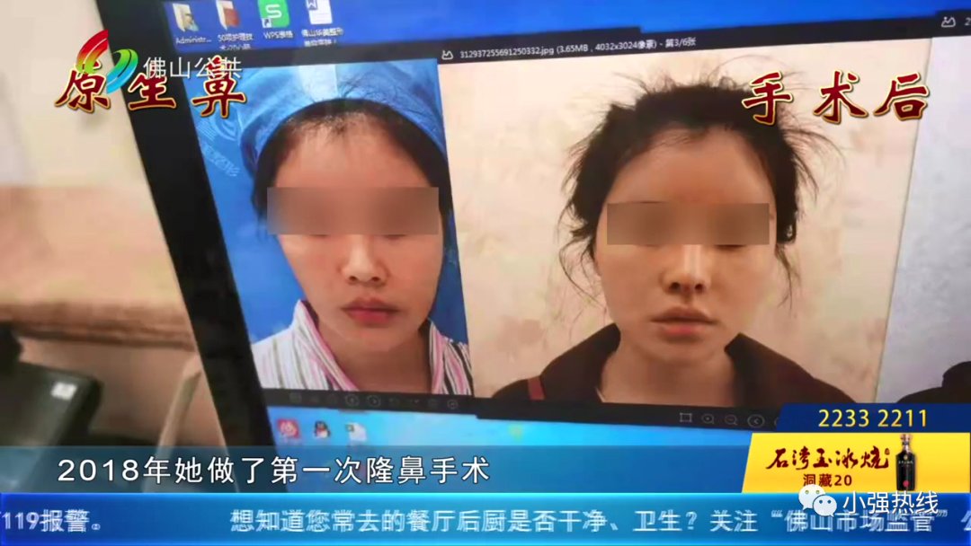 鼻孔 隆鼻后不满意，女子再做鼻子修复手术！这次仍不满意？