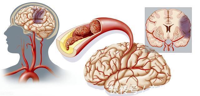 脑梗死|人到中年，不想中风，做好以下6点，让你活得更健康