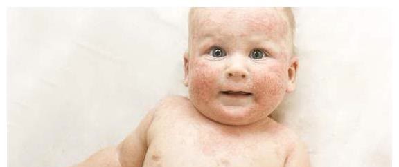 婴儿|冬季天气干冷,宝宝容易爆发湿疹?可能只是父母这三件小事没做对