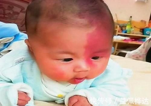 孕期|胎记是怎么来的?产科大夫:天生的除外,孕期这3种行为尽量避开