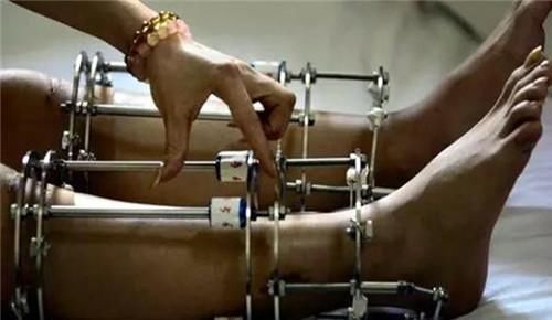 李亚诺|高三学生因身高矮小自卑,花16万断骨增高7.2厘米,如今怎样?