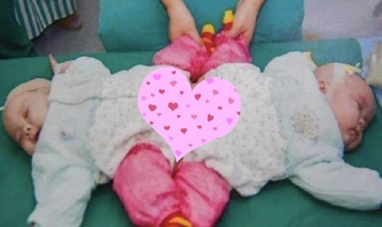 新生命|还记得国内首例“坐骨连体”双胞胎吗?13年过去了,她们现状如何