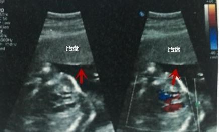 双顶径|B超单看男女?3分钟教你看懂B超检查单,简直不要太详细!