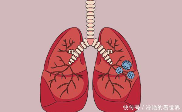  肺部|查出肺结节的人越来越多，根本原因是啥？该怎么处理？一文说清