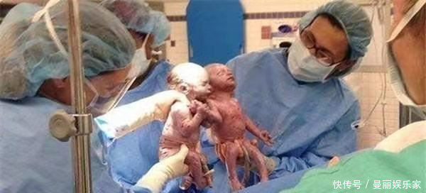 输卵管|双胞胎“手牵手”一起出生，画面瞬间感动医生，真的是太有爱了！