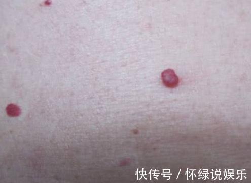 病变|如果你身上出现了2种痣，可能是肝脏病变，不注意就迟了