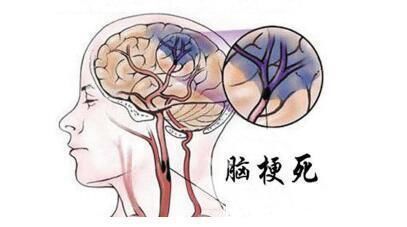 经验|不吃药，甘油三酯也能降下来！70岁老人的3条降脂经验，值得借鉴