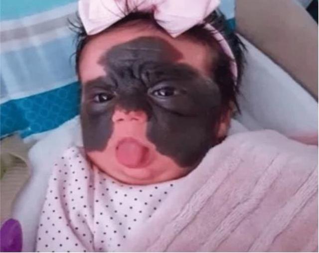 父母|女孩出生就带有“蝙蝠胎记”,做过7次整形手术,现在怎么样了