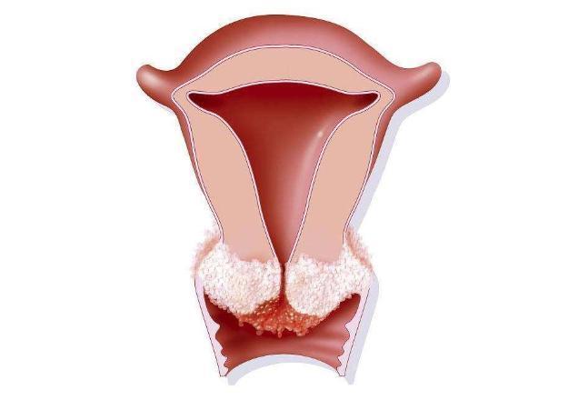 hpv|宫颈生了病，人的身上可能会出现2个变化，别不当一回事