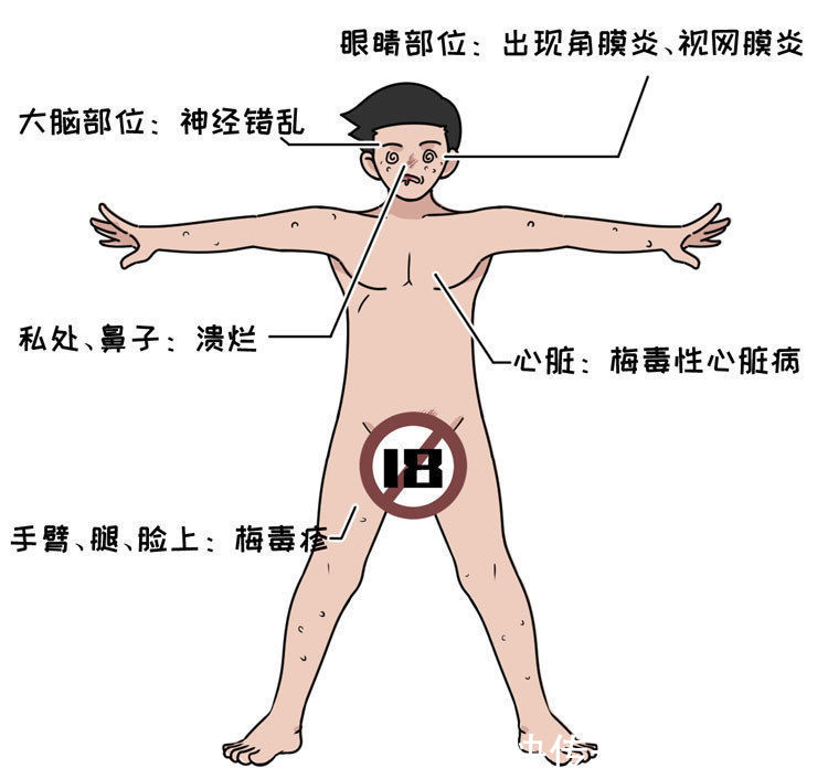 冠状沟|为什么有的男人会选择嫖娼？一次嫖娼会带来多少性病？长点记性吧