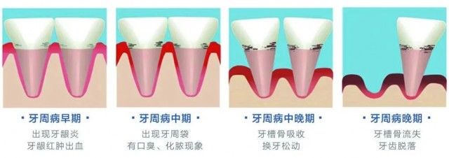 疾病|被10亿人忽视的口腔问题，正悄悄瓦解「全身系统」