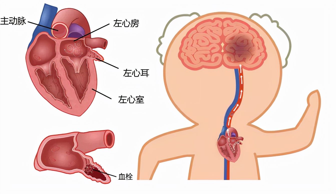 起搏器|“心门”坏了、冠脉堵塞、心脏乱跳,一根导管解决诸多心脏顽疾