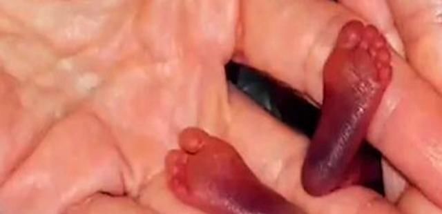 重症监护室|14年过去,原本身体巴掌大“世界最小宝宝”,如今颜值高到认不出