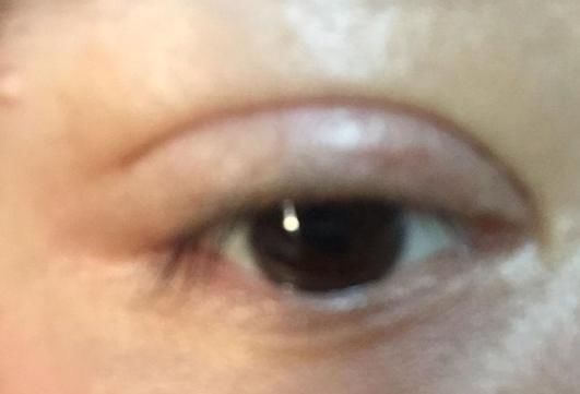 组织|双眼皮术后出现肉条的不同原因和修复方法
