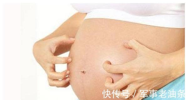 妊娠纹|孕期出现这三种情况,就是长妊娠纹的“征兆”,孕妈要提早预防