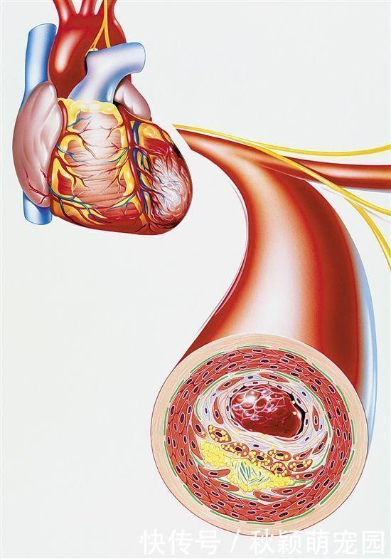 斑块|怎样才能把血管壁上的垃圾或斑块清除掉?医生告诉您答案!