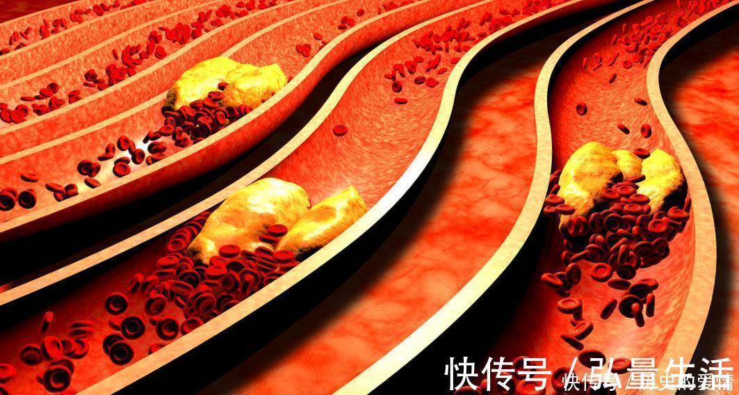克星|高血脂最怕的“克星”找到了，不是山楂，饭后吃1物，血脂悄悄降
