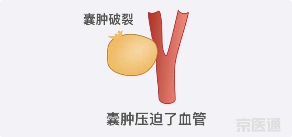 肝囊肿|结节、息肉、囊肿是癌症先兆吗?北肿专家们说出了真相!