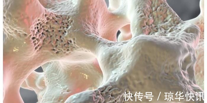 骨质疏松|稳固骨质的“冠军”找到了,不是钙片,没事敞开吃,提高骨密度