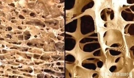 抑制骨|骨质疏松别老想着吃钙片,牢记“几个原则”,骨密度慢慢上涨