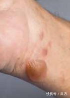 伤口|游乐设施“有毒”！这些危险你可能没想过→