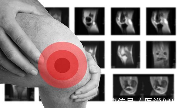 髌骨软化症|膝盖长期疼痛,很可能与这6种疾病有关,需重视来,注意保养