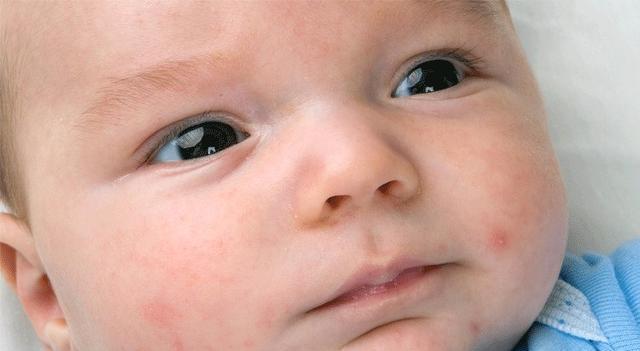 会长|新生儿也会长“青春痘”?这事全怪家长