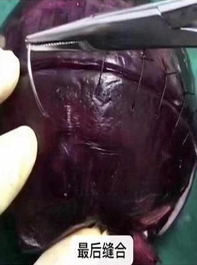 麻醉针|选剖腹产不疼这根10厘米的麻醉针仅仅是开始,疼到你怀疑人生